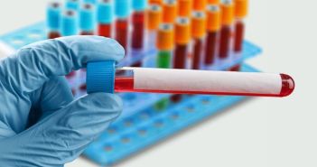 BD-tau Blutmarker misst frühzeitig Schlaganfallfolgen und prognostiziert Genesungschancen (Foto: AdobeStock - BillionPhotos.com - 486404804)